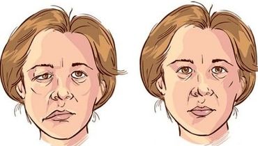 اختلالی که در زنان بالای 40 سال شایع تر است و سمت چپ صورت را درگیر می کند
