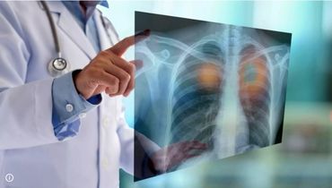 چگونه می‌توان سرطان ریه را زود تشخیص داد و درمان شد؟